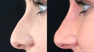 Nose Job in Dubai